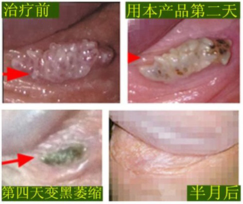尖锐湿疣会遗传吗?