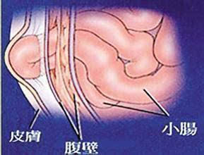 老汉剁鱼块用力过猛 撕破肚子疝气大如柚子