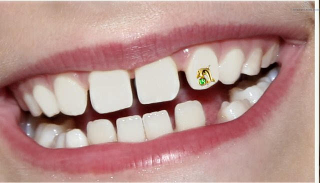 人们对于牙套的要求也不仅仅限于金色了,还有镶钻款,水晶款……各式各