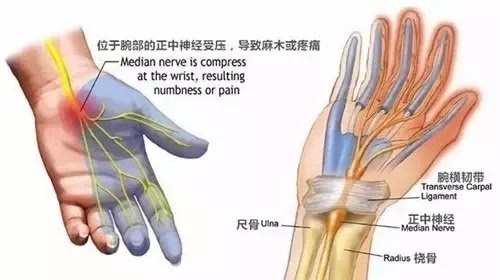 通常来说,大拇指麻木表示第六颈神经根受压;食指,中指,无名指表示第