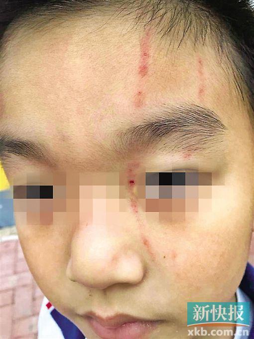 一年级男生被同学起名"老鱼头" 还被对方抓伤脸