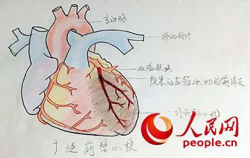 左冠状动脉前降支血供受阻造成心脏前壁,左室前侧壁,室间隔的前2/3