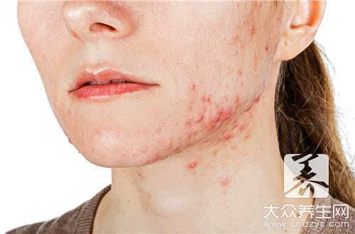 第一:内分泌旺盛导致人中长痘痘