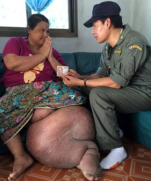 泰不幸单亲母亲受好心人资助治其巨腿