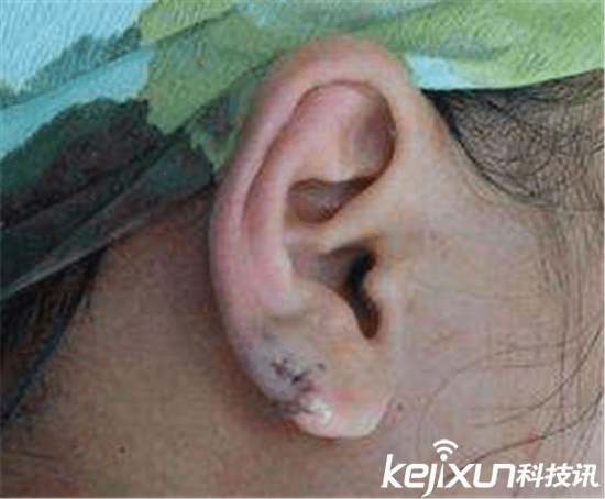 女子理发被剪耳垂 惹事理发师用卫生纸掏出剪下的耳垂!