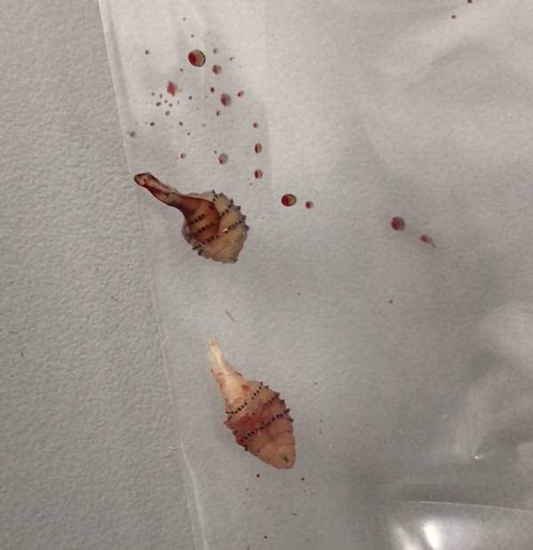 女子巴西旅游遭虫咬 回国后小腿取出2活虫
