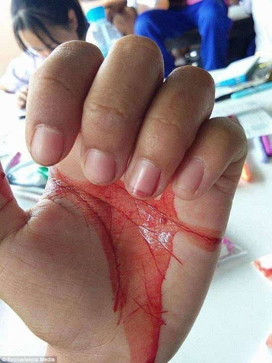 泰国女孩患神秘怪病 头痛时眼鼻耳和皮肤都流血