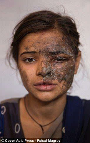 khushboo的脸部被她的父亲泼了硫酸,伤势比较严重.