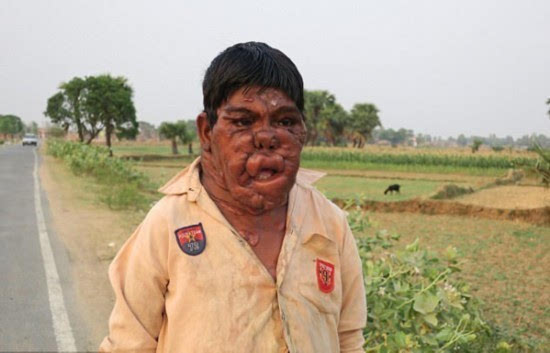 印幽灵男孩患罕见疾病 面部与身体布满肿瘤