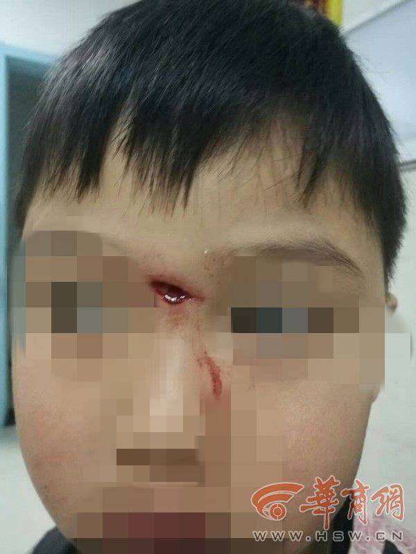 商洛5岁男童幼儿园里一个多月摔两次 脸部缝了12针