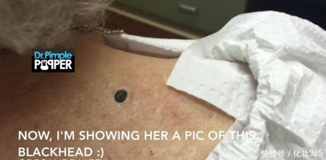 女儿带着86岁妈妈找医生挤黑头,拔出来后让人