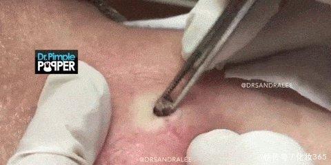 女儿带着86岁妈妈找医生挤黑头,拔出来后让人