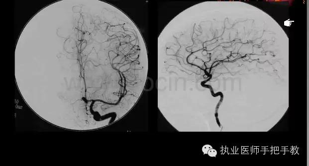 图解 | 如何轻松看懂脑血管造影?