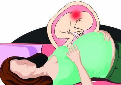 婴儿斜颈增多疑与孕妇左侧卧有关