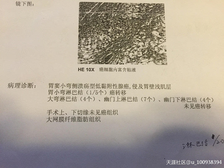 手术后病理报告  胃窦小弯侧溃疡型低黏附件腺癌,侵及胃壁浅肌层  胃