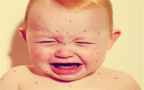 小孩出麻疹怎么办