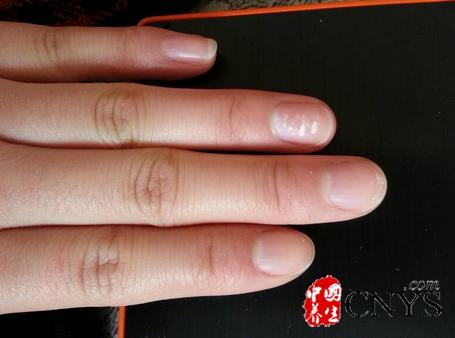 肾虚的症状指甲上发现白斑80是肾虚