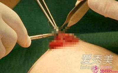重庆一女子做隆胸手术次日死亡 震撼实拍美女