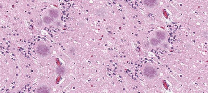 图片说明:脑组织切片显示在克雅氏病的病变组织内有典型的空泡蛋白斑