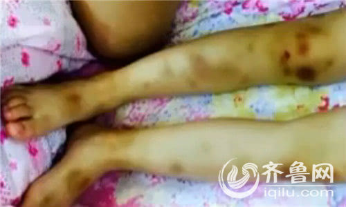 山东济南一个3岁大的小女孩腿上,腰上,胳膊上伤痕累累,让人看了触目