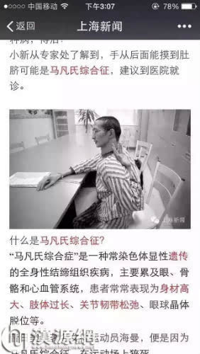 什么是马凡氏综合症?