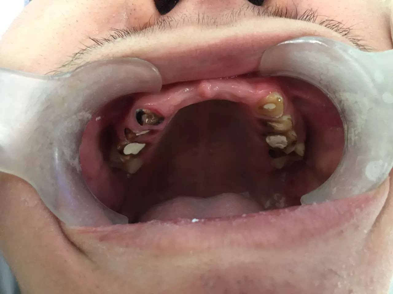 19岁高中生一口牙齿拔掉8颗 折断10颗!他这个习惯很多孩子都有