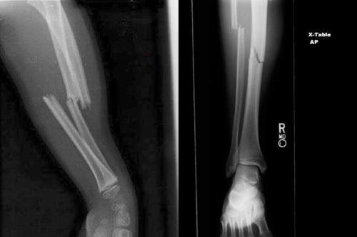 近日,卢克肖伤腿x光照片曝光,两处骨折清晰可见.