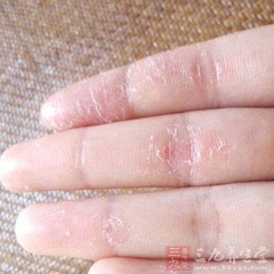 手指脱皮是怎么回事 如何拯救换季脱皮问题