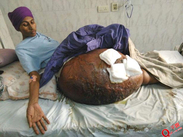 男子腿部长110斤重巨型肿瘤 是体重的1.5倍!