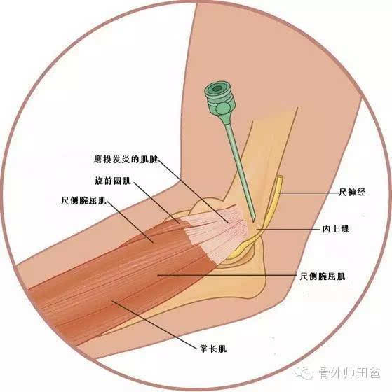 不打高尔夫也会得高尔夫球肘