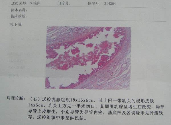 乳腺内异常钙化灶导丝定位活检