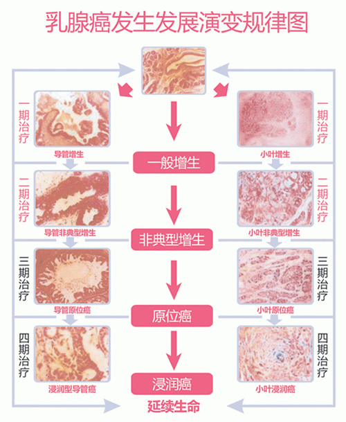 乳腺增生