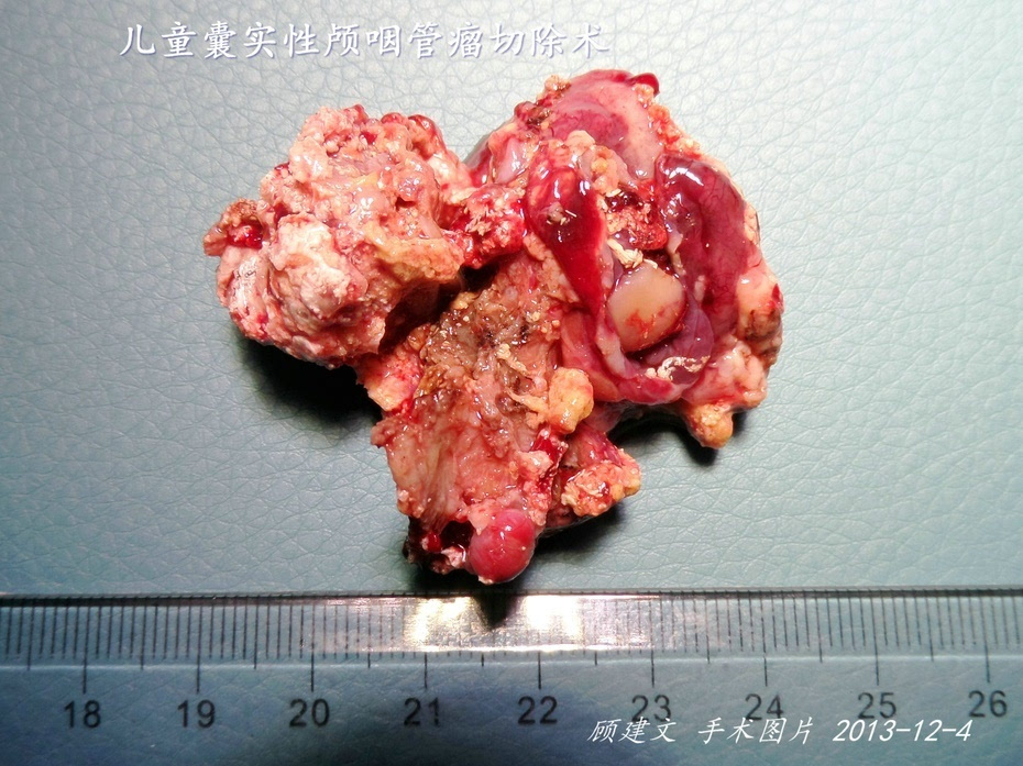 囊实性巨大钙化颅咽管瘤切除术