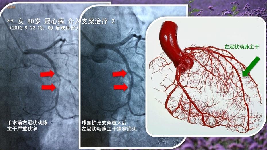 冠状动脉性心脏病