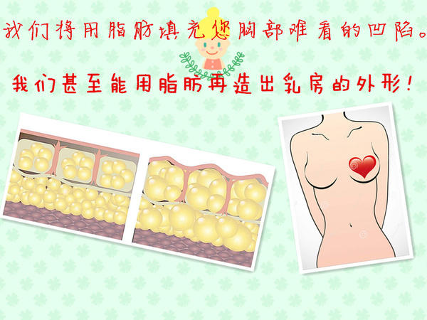 乳房再造,您考虑过用自体脂肪吗?