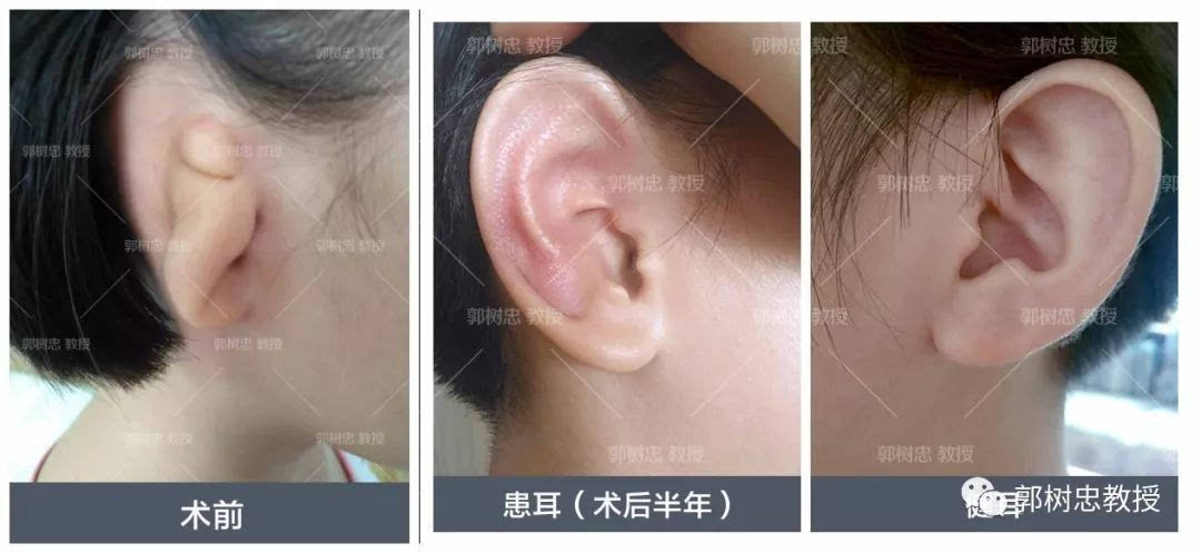 症 小耳