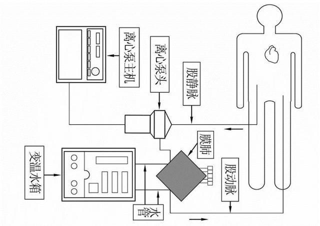 ecmo——体外膜肺氧合