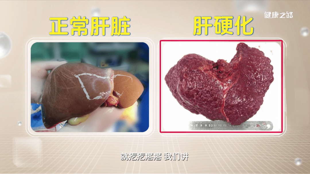 正常的肝脏vs肝硬化