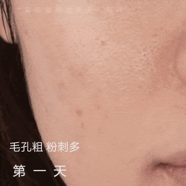 我鼻翼两边粗粗的地方,像打了气的气球,pong了起来,黑头, 脏东西都揉