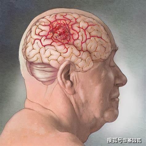 脑胶质瘤鉴别诊断基础简介