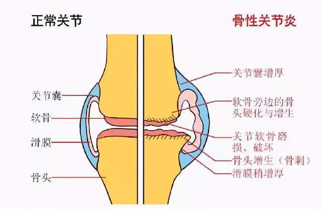 积水潭医院专家:膝关节不好,不想手术?需要牢记这8点