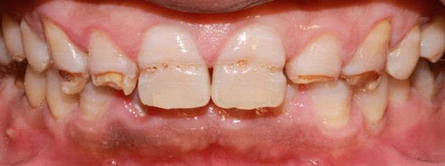 牙釉质钙化不全图片图片
