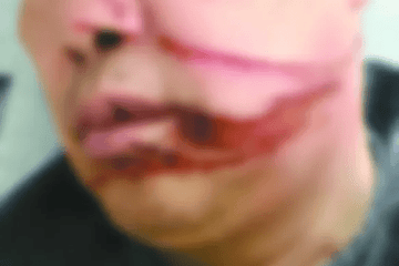 触目惊心！一男子骑车遭割脸，称“突然发现，避让不及”