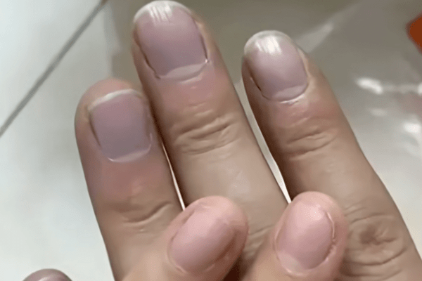 女子发现老公手指甲发紫，劝他去医院被怼“吃饱了没事干”，几天后老公突然胸痛被120拉走，急救人员称或为心梗，医生：手指发紫别大意