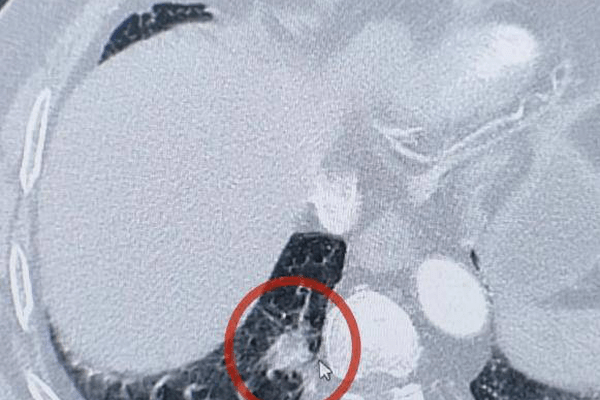 体检查出2.1cm肺结节，多家医院诊断为“肺癌”；医生切开笑了：是个红色辣椒尖，从业近30年仅遇3例