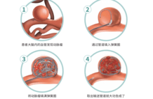 直面大脑 “不定时炸弹”，他们的日常有多惊心动魄？