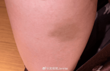 吴艳妮晒出身上多处淤青照：身体吃不消的无力感，基本上每天训练后的康复都要喜提一枚“勋章”