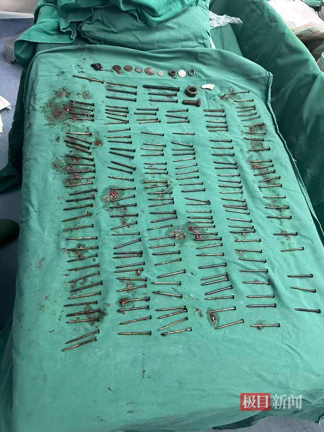 云南一男子胃中取出180颗铁钉，医生称还有硬币和磁铁等，总重超1公斤，家属回应