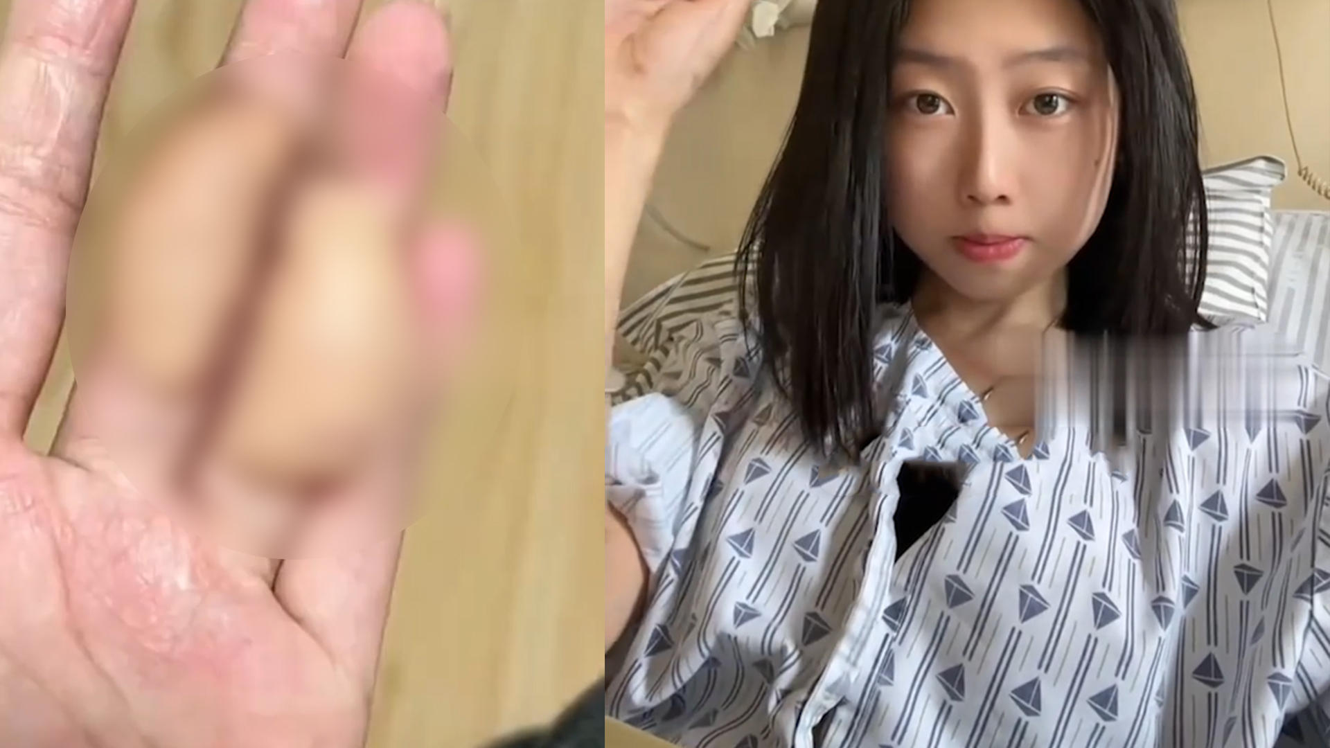 00后女生手指被电伤，从肚子“借肉”移植后形似猫爪垫，当事人：哭是一天，笑也是一天