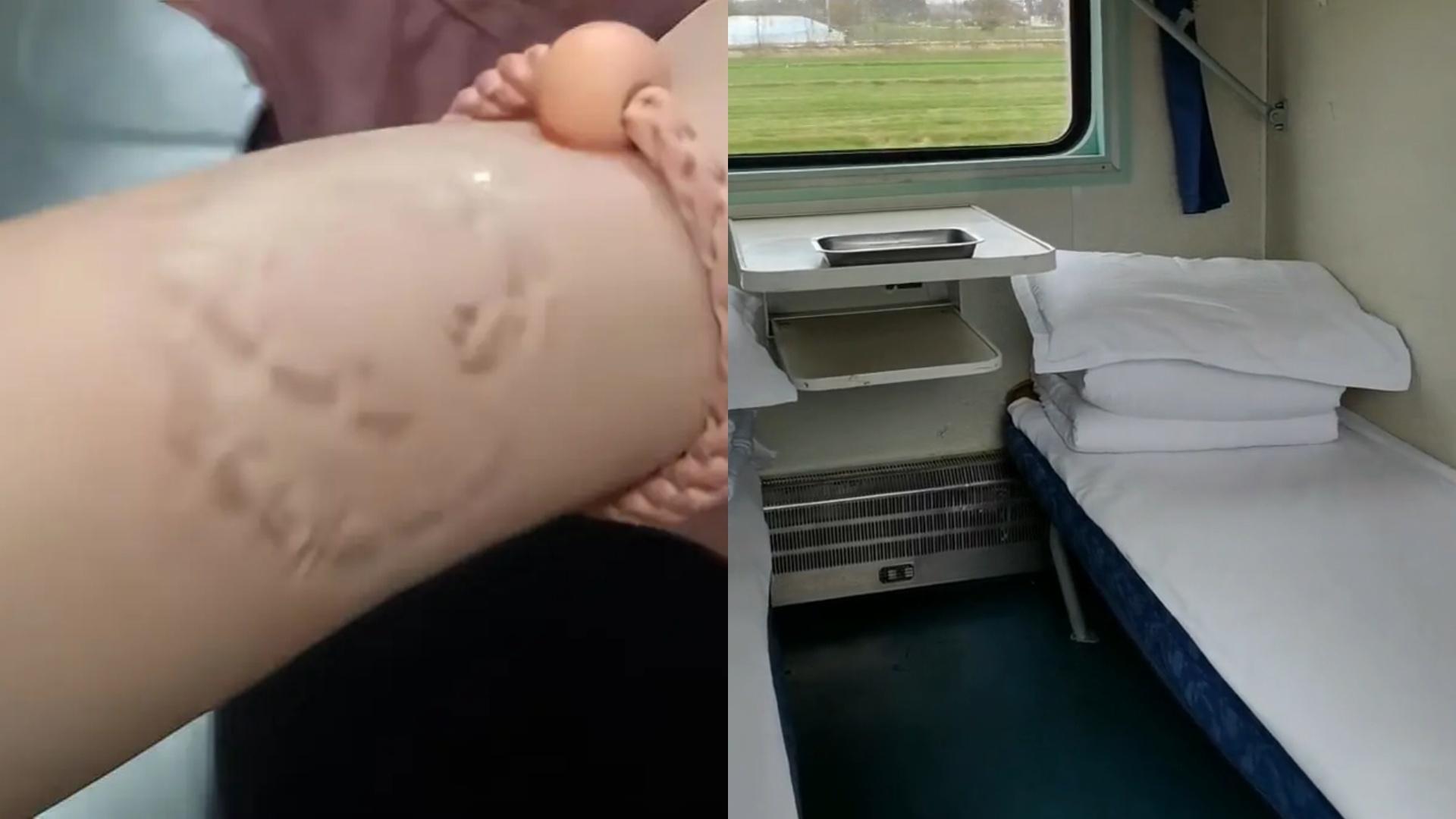 女子火车卧铺被大妈占据，争吵中被咬伤了手腕，几天后伤口处出现水疱